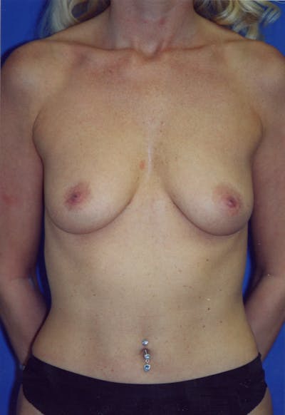 Breast Lift With Implant Before & After Gallery - Patient 116243076 - Image 1