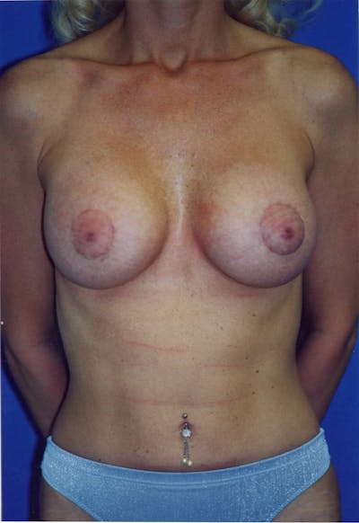 Breast Lift With Implant Before & After Gallery - Patient 116243076 - Image 2