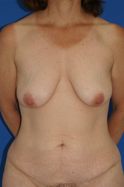 Breast Lift With Implant Before & After Gallery - Patient 116243083 - Image 1