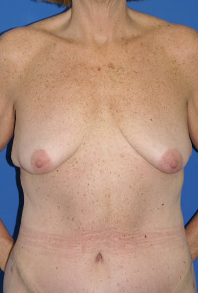 Breast Lift With Implant Before & After Gallery - Patient 116243091 - Image 1