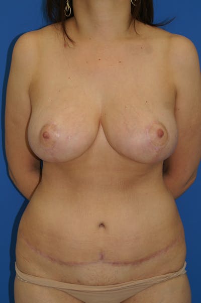 Breast Reduction Before & After Gallery - Patient 116243104 - Image 2