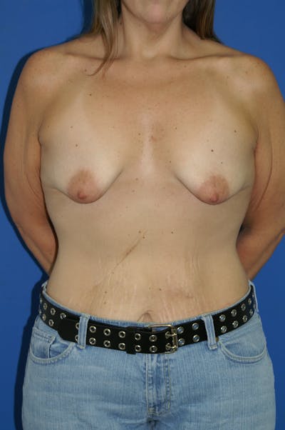 Breast Lift With Implant Before & After Gallery - Patient 116243139 - Image 1