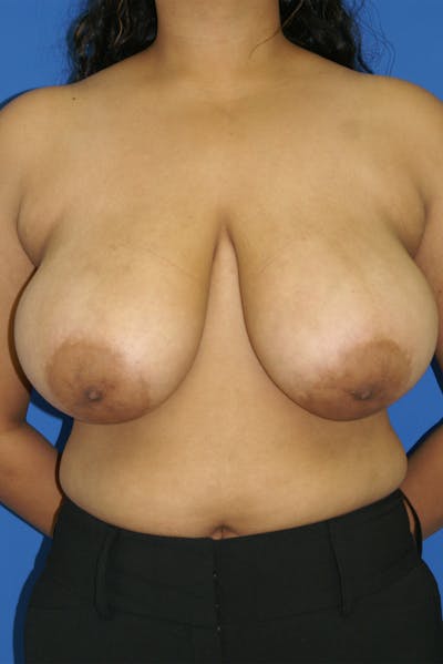 Breast Reduction Before & After Gallery - Patient 116243385 - Image 1