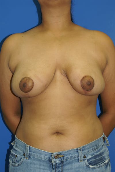 Breast Reduction Before & After Gallery - Patient 116243385 - Image 2