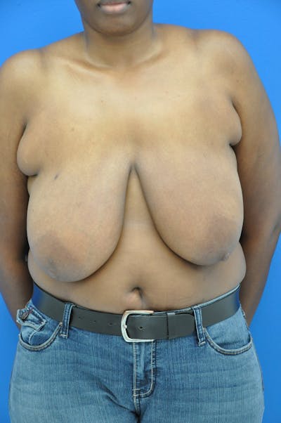 Breast Reduction Before & After Gallery - Patient 116243395 - Image 1