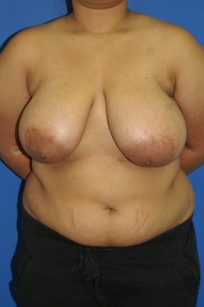 Breast Reduction Before & After Gallery - Patient 116243407 - Image 1