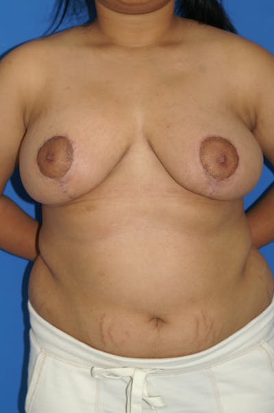 Breast Reduction Before & After Gallery - Patient 116243407 - Image 2