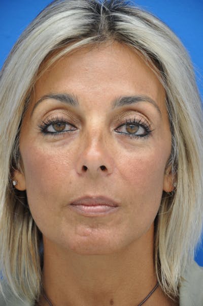 Brow Lift Before & After Gallery - Patient 116252672 - Image 2