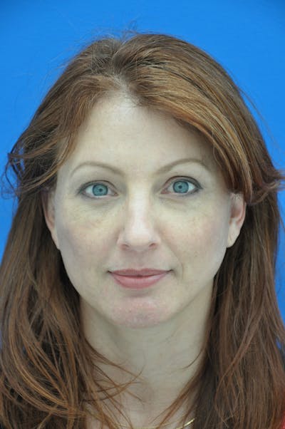 Facelift Before & After Gallery - Patient 116252678 - Image 2