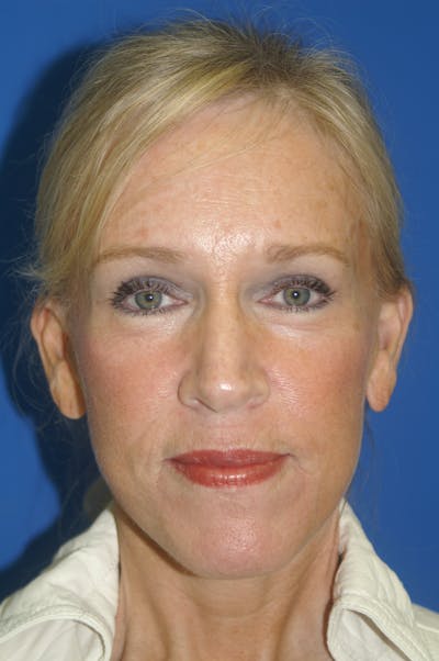 Brow Lift Before & After Gallery - Patient 116252676 - Image 2