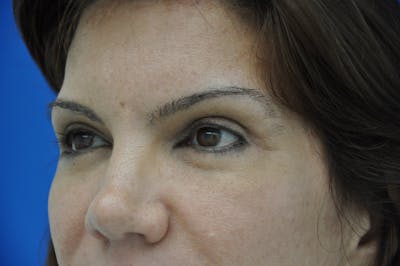 Eyelid Surgery Before & After Gallery - Patient 116252674 - Image 2