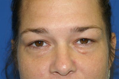 Eyelid Surgery Before & After Gallery - Patient 116252679 - Image 1