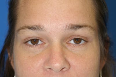 Eyelid Surgery Before & After Gallery - Patient 116252679 - Image 2