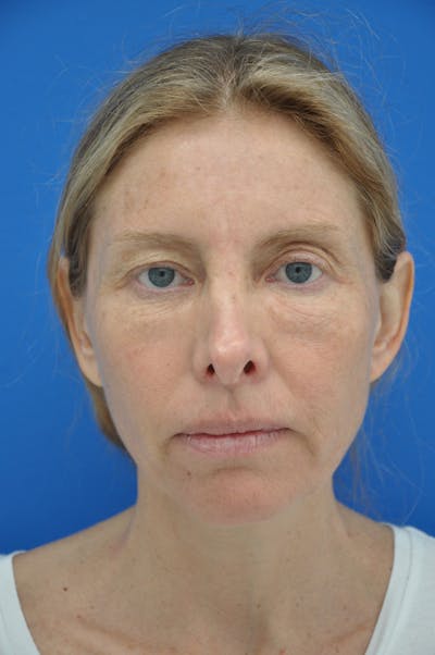 Brow Lift Before & After Gallery - Patient 116252681 - Image 1