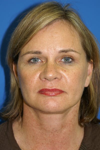 Facelift Before & After Gallery - Patient 116252683 - Image 2