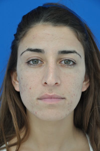 Rhinoplasty Before & After Gallery - Patient 116252688 - Image 1