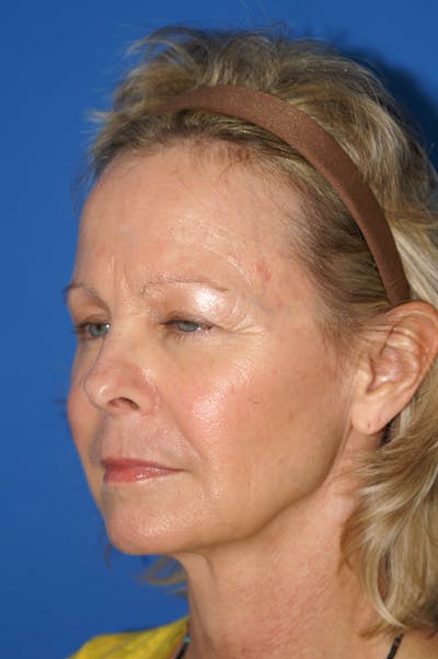 Eyelid Surgery Before & After Gallery - Patient 116252685 - Image 1