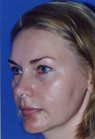Brow Lift Before & After Gallery - Patient 116252690 - Image 1