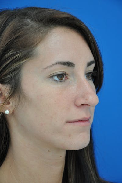 Rhinoplasty Before & After Gallery - Patient 116252708 - Image 1