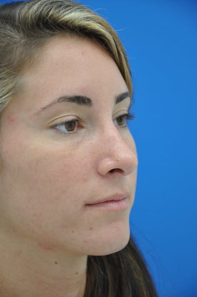 Rhinoplasty Before & After Gallery - Patient 116252708 - Image 2