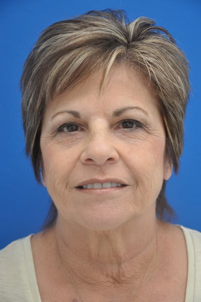 Brow Lift Before & After Gallery - Patient 116252717 - Image 1