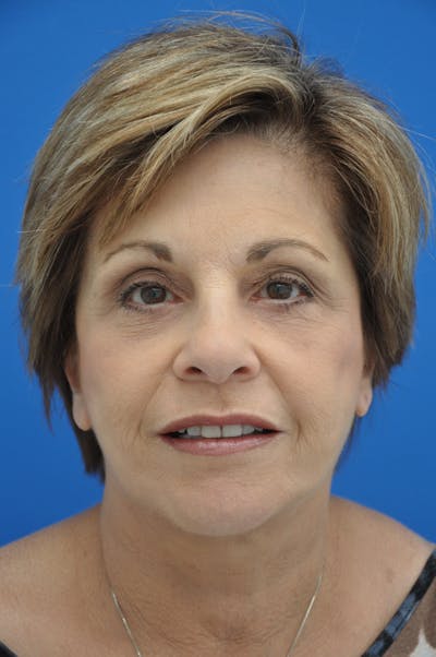Brow Lift Before & After Gallery - Patient 116252717 - Image 2