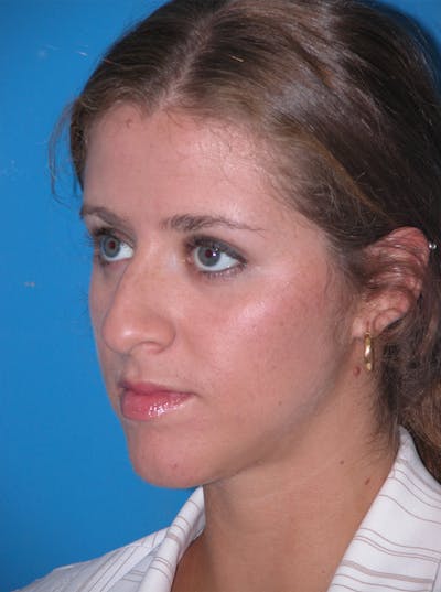 Rhinoplasty Before & After Gallery - Patient 116252719 - Image 1