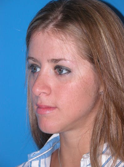 Rhinoplasty Before & After Gallery - Patient 116252719 - Image 2