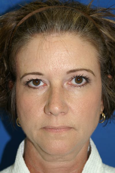 Brow Lift Before & After Gallery - Patient 116252721 - Image 1