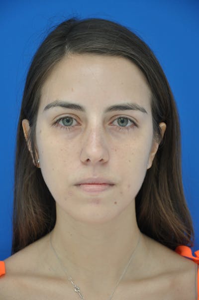 Rhinoplasty Before & After Gallery - Patient 116252729 - Image 1