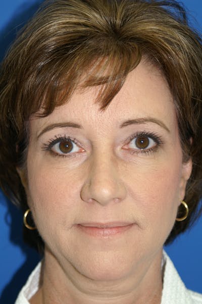 Brow Lift Before & After Gallery - Patient 116252721 - Image 2