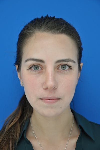 Rhinoplasty Before & After Gallery - Patient 116252729 - Image 2
