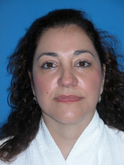 Facelift Before & After Gallery - Patient 116252741 - Image 2
