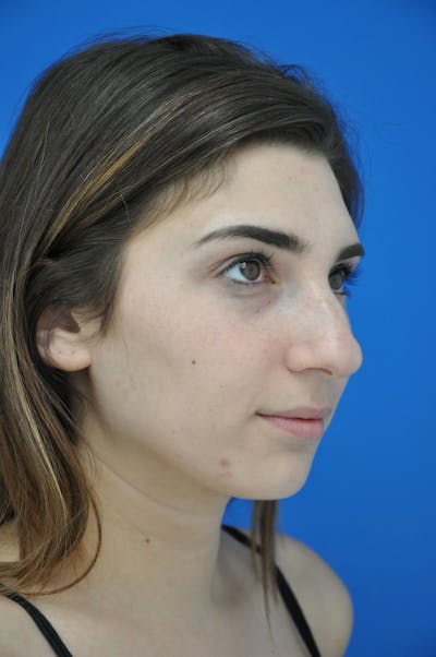 Rhinoplasty Before & After Gallery - Patient 116252746 - Image 1