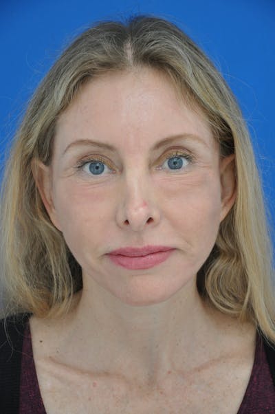 Facelift Before & After Gallery - Patient 116252749 - Image 2