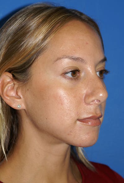 Rhinoplasty Before & After Gallery - Patient 116252756 - Image 1