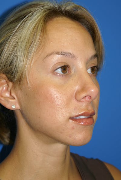 Rhinoplasty Before & After Gallery - Patient 116252756 - Image 2