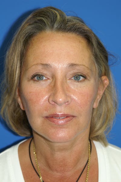 Facelift Before & After Gallery - Patient 116252773 - Image 2