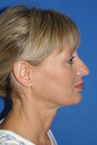 Rhinoplasty Before & After Gallery - Patient 116252774 - Image 1
