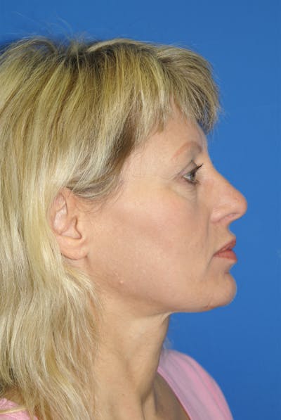 Rhinoplasty Before & After Gallery - Patient 116252774 - Image 2