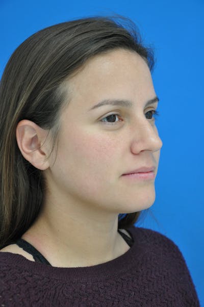 Rhinoplasty Before & After Gallery - Patient 116252777 - Image 1