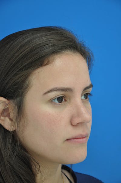 Rhinoplasty Before & After Gallery - Patient 116252777 - Image 2