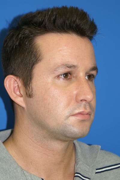 Rhinoplasty Before & After Gallery - Patient 116252779 - Image 2