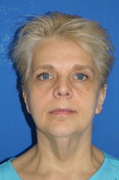 Facelift Before & After Gallery - Patient 116252782 - Image 1