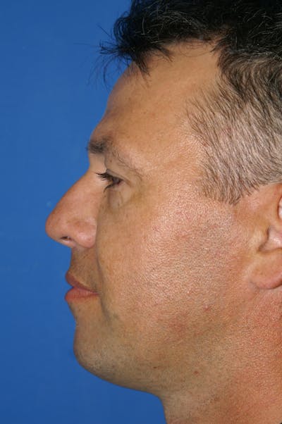 Rhinoplasty Before & After Gallery - Patient 116252783 - Image 1