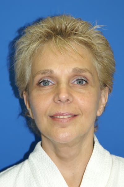 Facelift Before & After Gallery - Patient 116252782 - Image 2