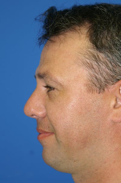 Rhinoplasty Before & After Gallery - Patient 116252783 - Image 2