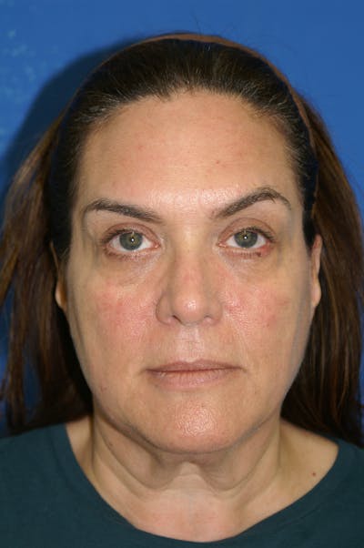 Facelift Before & After Gallery - Patient 116252803 - Image 1