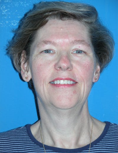 Facelift Before & After Gallery - Patient 116252805 - Image 1