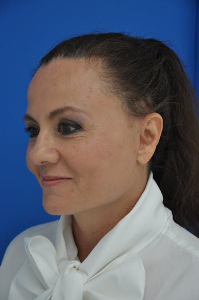 Facelift Before & After Gallery - Patient 116252807 - Image 2